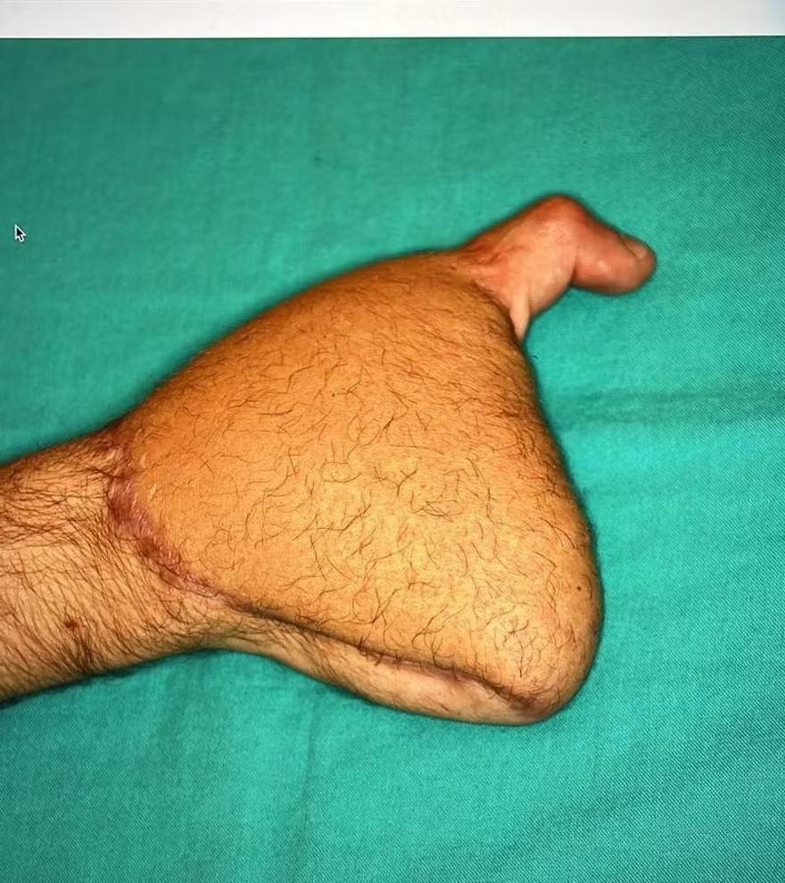 La mano derecha de Diego antes de la intervención