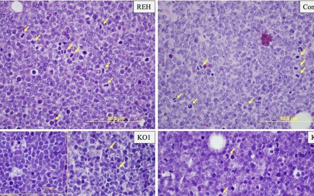 Leucemia aguda linfoblástica. Leucemia aguda linfoblástica.