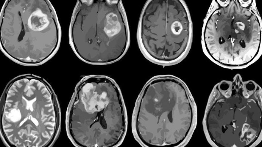 Glioblastoma, el tumor cerebral más agresivo mapeado en detalle genético y molecular.