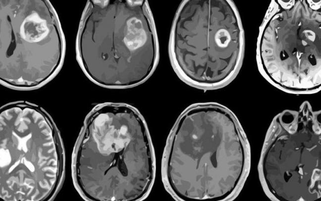 Glioblastoma, el tumor cerebral más agresivo mapeado en detalle genético y molecular. Glioblastoma, el tumor cerebral más agresivo mapeado en detalle genético y molecular.