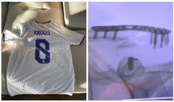 La camiseta de Kroos que le regaló su madre para suplir la rota en el accidente y la radiografía con los tornillos.
