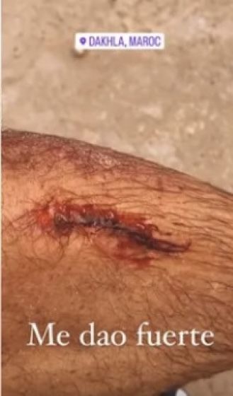 Foto de la herida que Adrián Lastra se hizo practicando kitesurf.