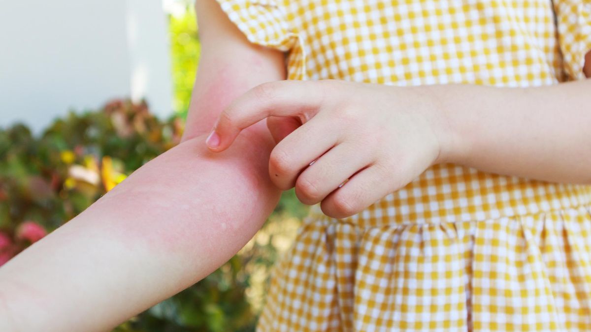 Con el calor y el sudor suelen aparecer sarpullidos o erupciones en los pliegue de la piel