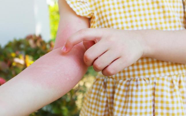 Con el calor y el sudor suelen aparecer sarpullidos o erupciones en los pliegue de la piel