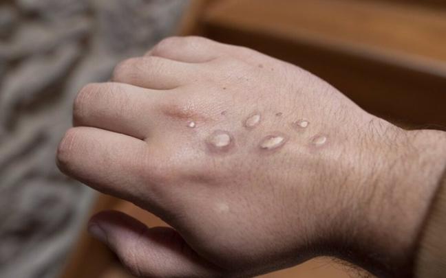 Un hombre contagiado con la viruela del mono Un hombre contagiado con la viruela del mono