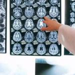 La Organizaci&oacute;n Mundial de la Salud conmemora cada a&ntilde;o, el 29 de octubre, el D&iacute;a Mundial del Ictus.