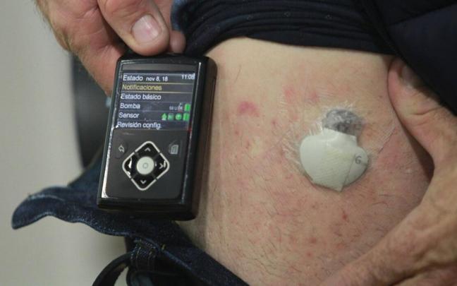 Imagen de archivo de un paciente con diabetes mostrando la bomba de insulina (izquierda) y el sensor de medición, en la pierna.