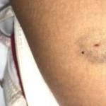 Imagen de archivo de un pinchazo por sumisi&oacute;n qu&iacute;mica.