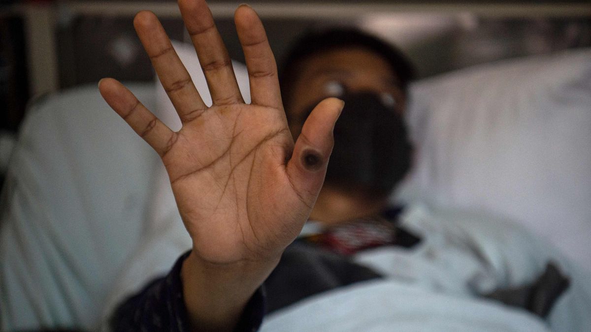 Un hombre contagiado con viruela del mono muestra sus secuela desde un hospital de Lima.