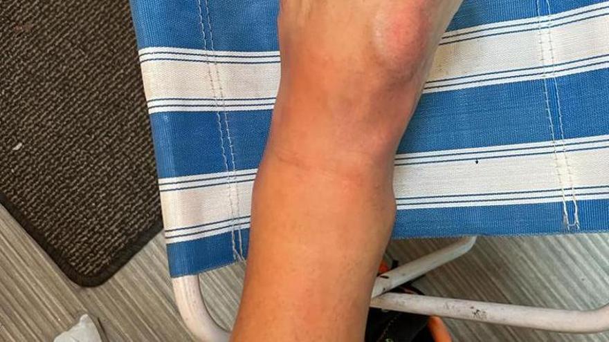 El tobillo lesionado.