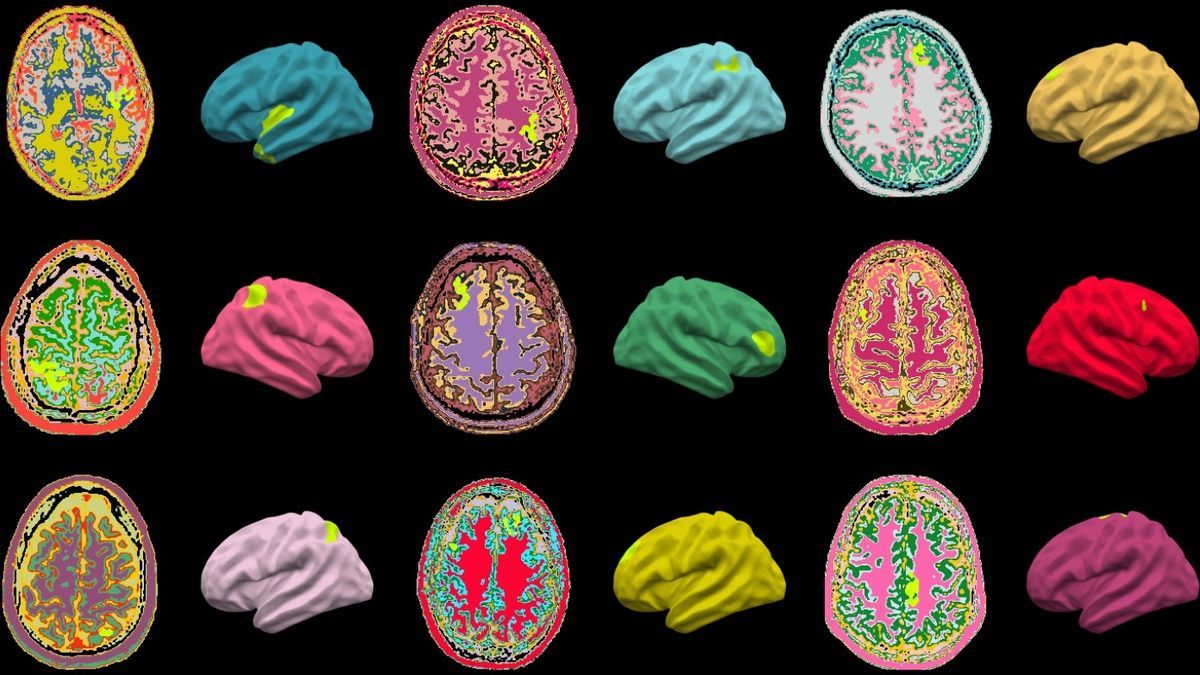 Anomalías cerebrales identificadas por el algoritmo MELD AI (resaltadas en verde lima).