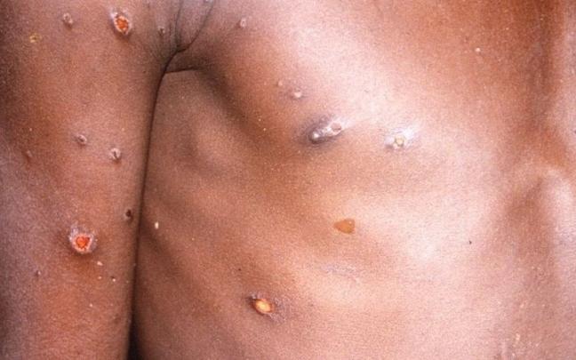 Lesiones provocadas por la viruela del mono