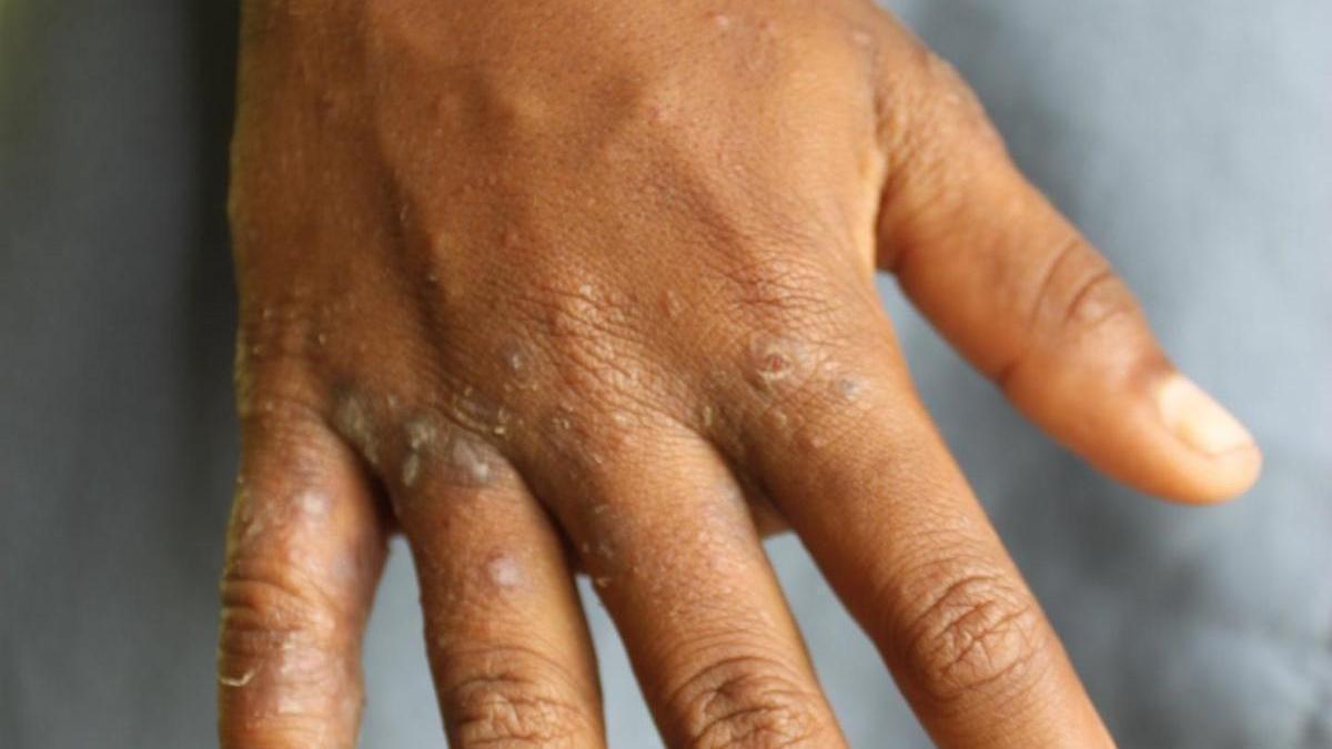 Imagen de una persona afectada de sarna.