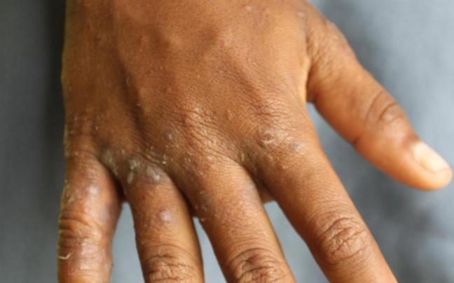 Imagen de una persona afectada de sarna.