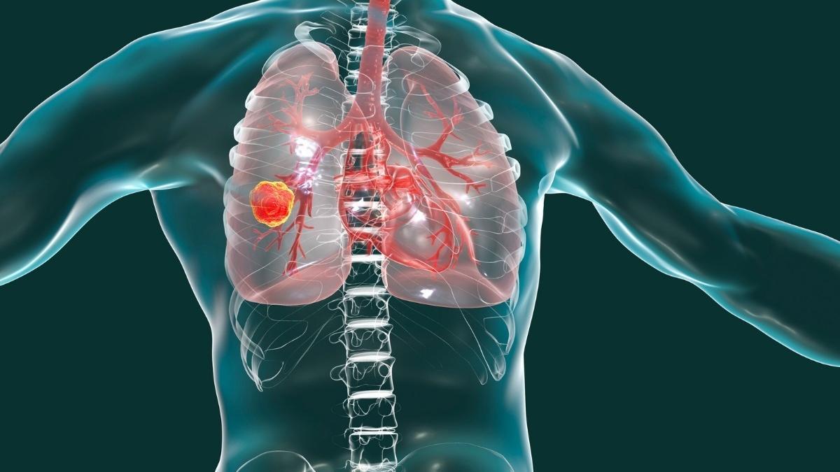 Cáncer de pulmón.