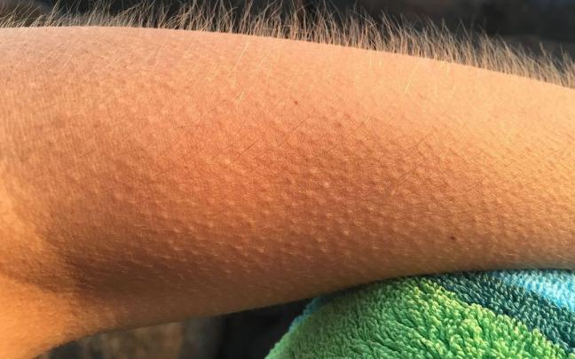 Un brazo con 'piel de gallina'. Un brazo con 'piel de gallina'.