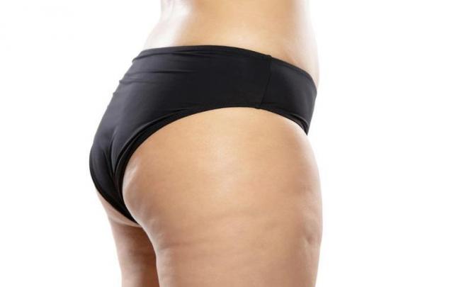 Existen diferentes factores que causan la celulitis.