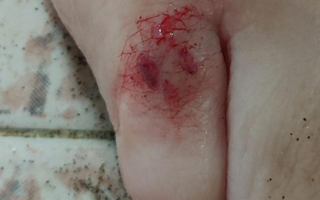 Imagen de una mordedura del pez ballesta