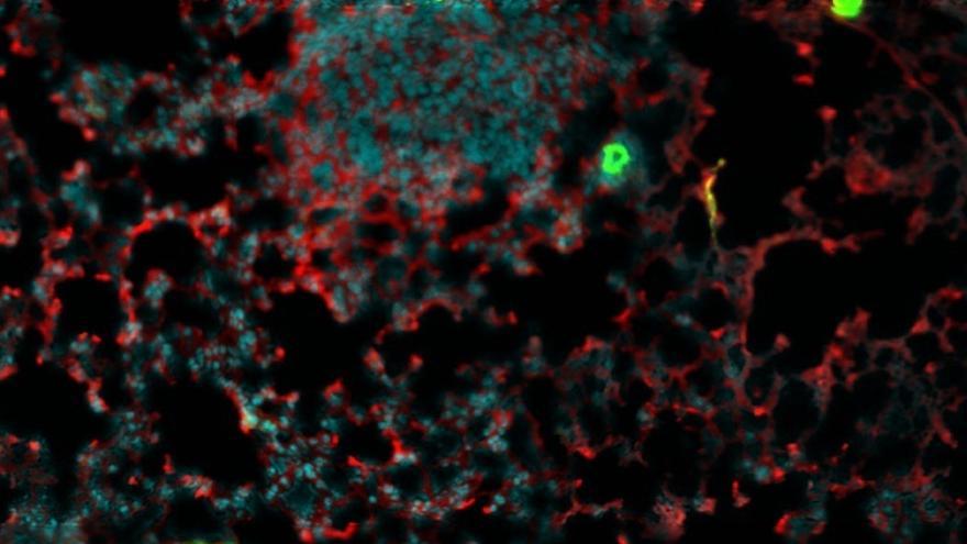 Imagen de un pulmón con metástasis de cáncer de mama, rodeado de proteína inflamatoria del complemento.