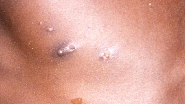 Imagen de las lesiones en la piel provocadas por la viruela del mono.