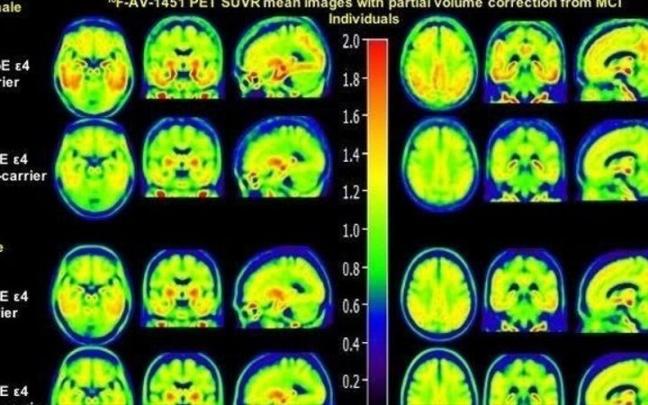 Imagen de PET de cómo el sexo modula el efecto de ApoE e4. Imagen de PET de cómo el sexo modula el efecto de ApoE e4.