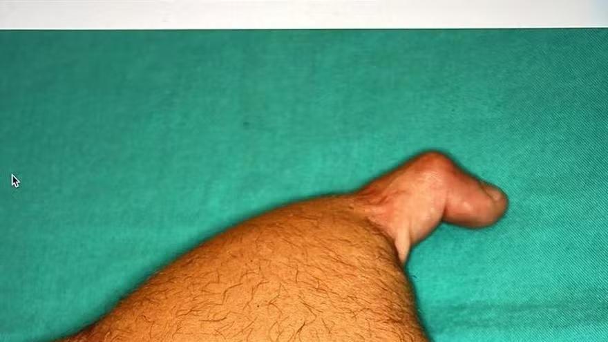 La mano derecha de Diego antes de la intervención.