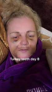 Una mujer con la cara amoratada tras someterse al tratamiento dental.