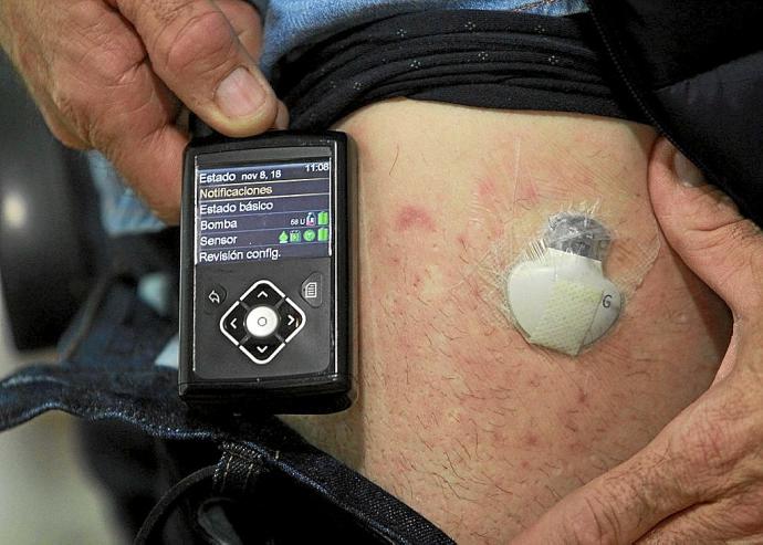 Un paciente diabético muestra la insulina y el sensor de medición, en la pierna. Foto: Oskar Montero