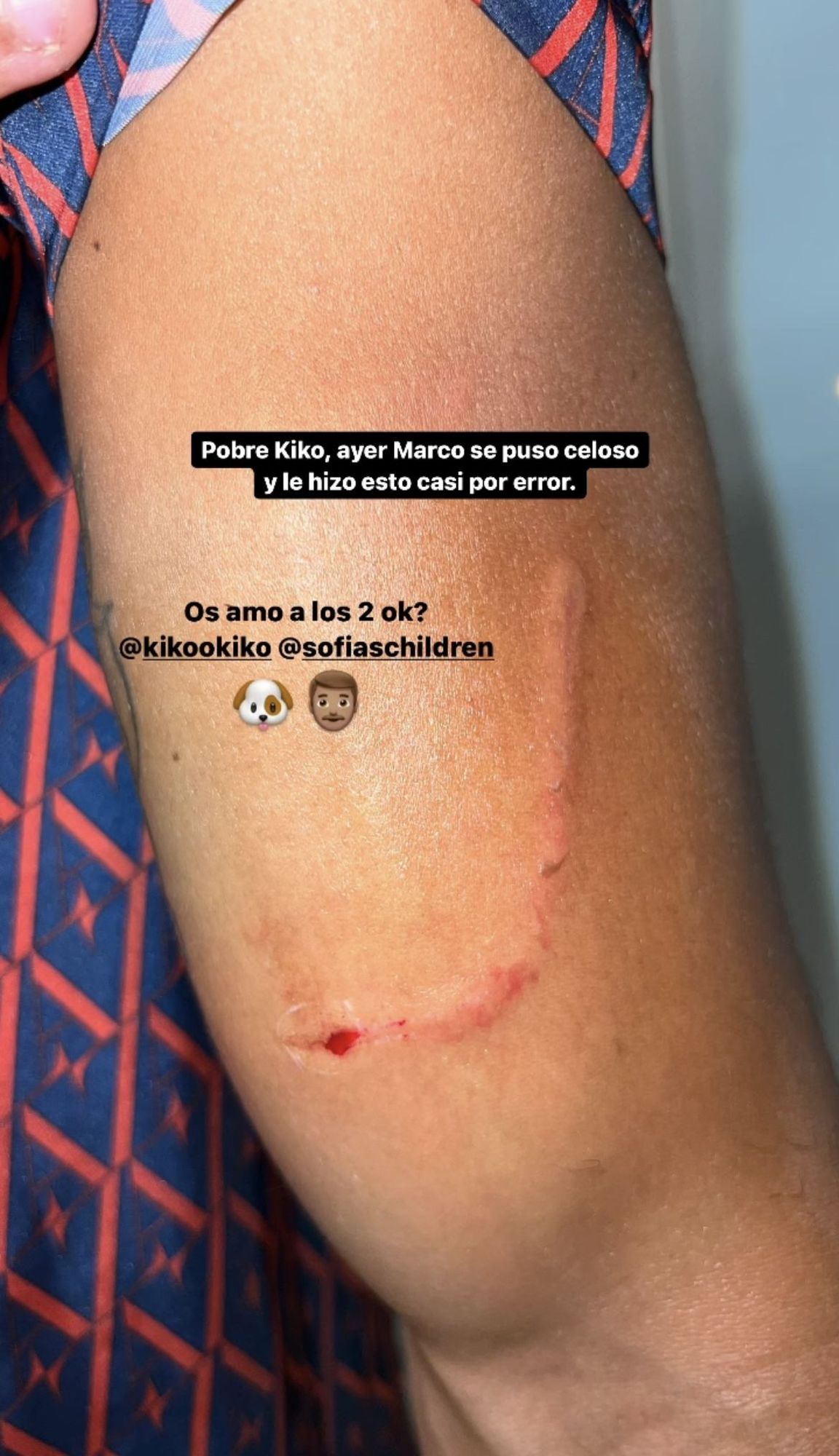 Sofía Suescun muestra las secuelas de Kiko Jiménez tras el incidente.