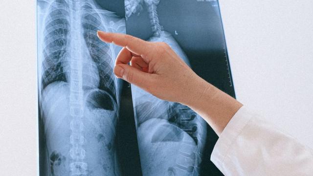 Más de 1,8 millones de personas mueren cada año de cáncer de pulmón.