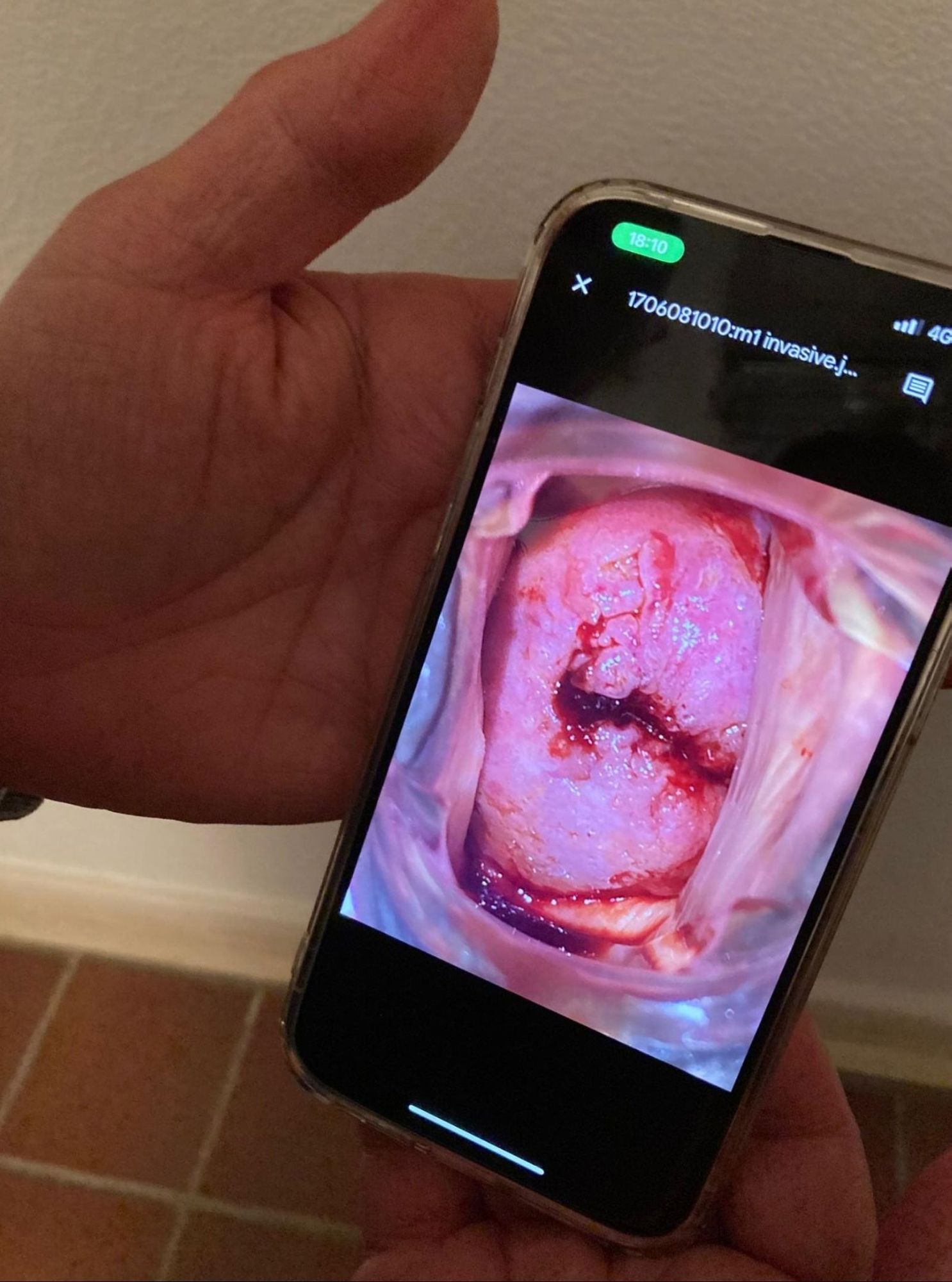 Imagen del cuello uterino de una paciente tratada con ácido acético tomada con un 'smartphone' por un profesional sanitario no especializado y enviada al experto para su evaluación.