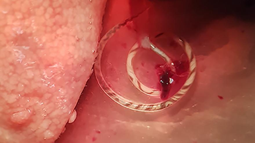 Angiostrongylus cantonensis emergiendo de la arteria pulmonar de una rata capturada en zona de huerta de Valencia.
