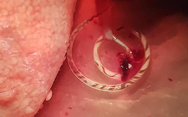 Angiostrongylus cantonensis emergiendo de la arteria pulmonar de una rata capturada en zona de huerta de Valencia. Angiostrongylus cantonensis emergiendo de la arteria pulmonar de una rata capturada en zona de huerta de Valencia.