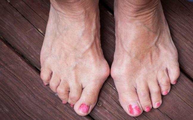 Imagen de una mujer que sufre de juanetes.