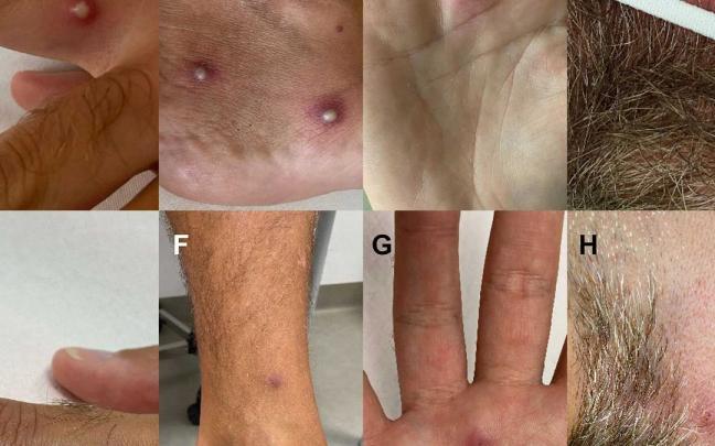 Algunas de las lesiones cutáneas del paciente.