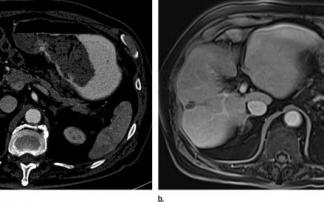 Descubren una combinación de inmunoterapia para el cáncer de hígado Descubren una combinación de inmunoterapia para el cáncer de hígado