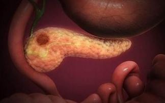 Este estudio podría ofrecer una nueva estrategia para combatir el cáncer de páncreas.