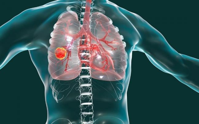 La bacteria Pseudomonas aeruginosa es una de las principales causas de la neumonía