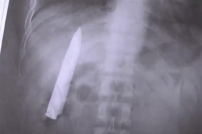 La radiografía muestra el cuchillo dentro del torso del afectado.