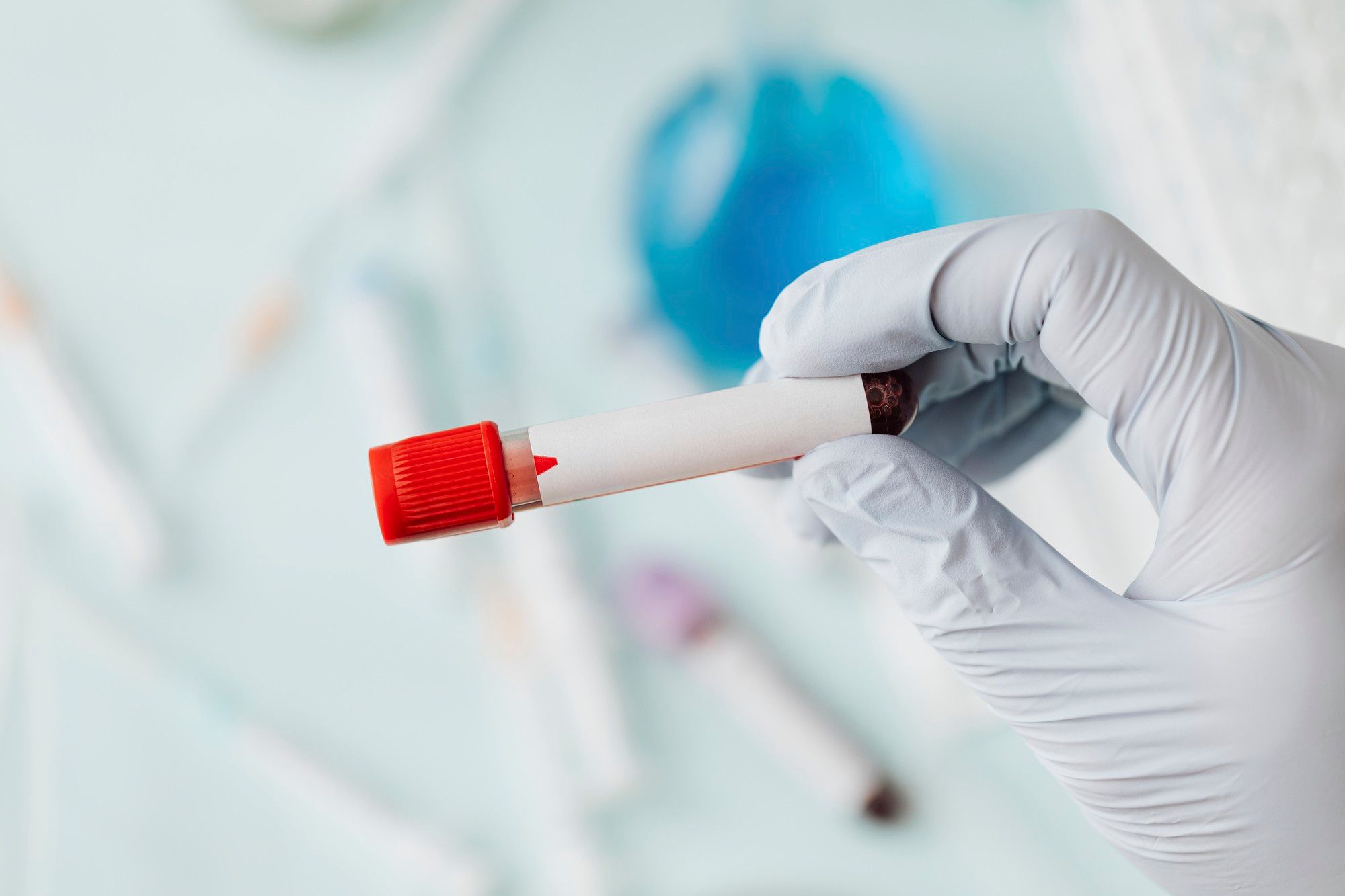 Un tubo con la sangre extraída.