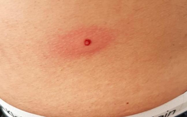 Herida del controlador