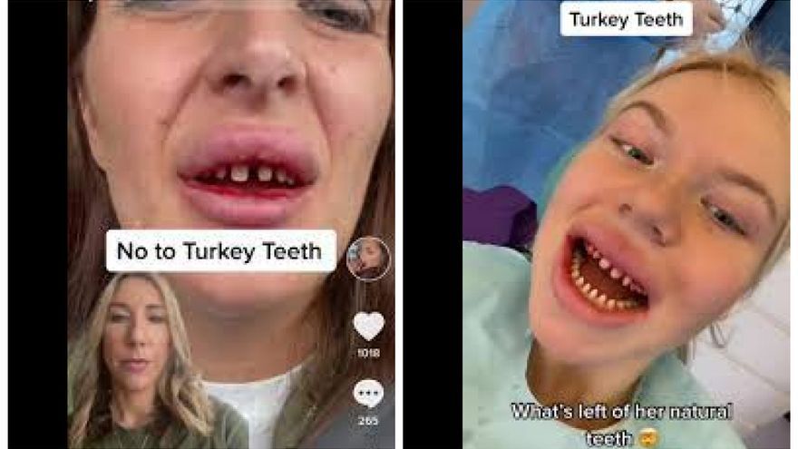 Dos mujeres muestran sus dientes tras el tratamiento dental en Turquía.