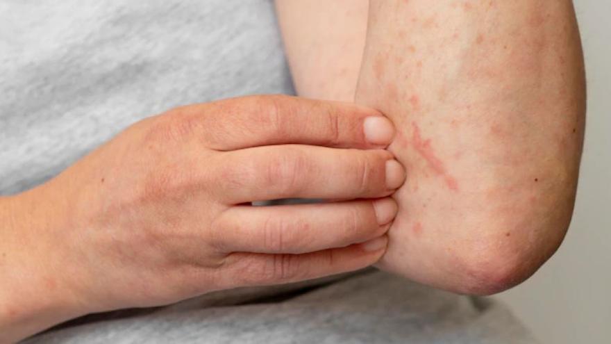 La dermatitis atópica es una enfermedad crónica.