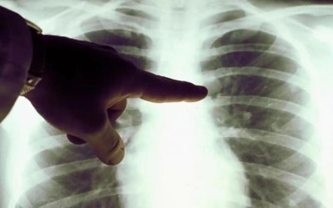 Radiografía de un enfermo de cáncer de pulmón