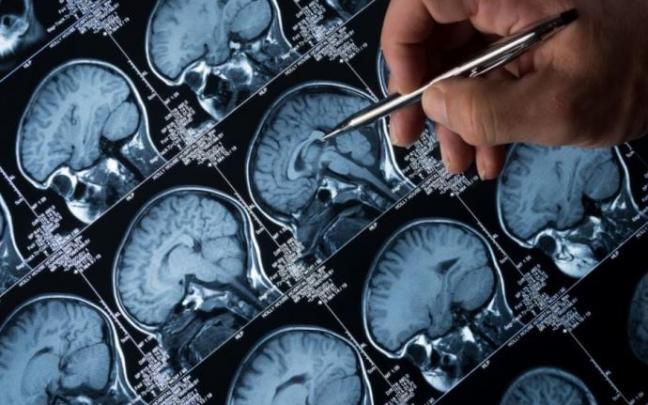 La epilepsia es uno de los trastornos neuronales más comunes.