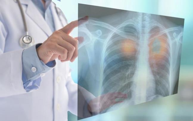 Cáncer de pulmón. Cáncer de pulmón.