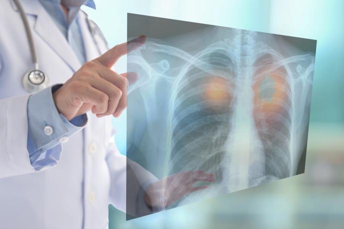 La investigación ha ratificado el cambio de paradigma en el abordaje del cáncer de pulmón precoz.