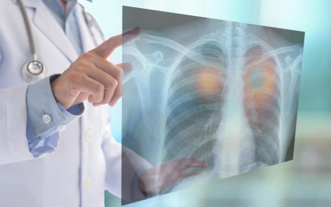La investigación ha ratificado el cambio de paradigma en el abordaje del cáncer de pulmón precoz. La investigación ha ratificado el cambio de paradigma en el abordaje del cáncer de pulmón precoz.
