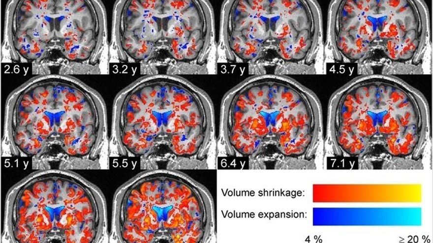 Degeneración progresiva del tejido cerebral en un paciente con enfermedad de Párkinson.