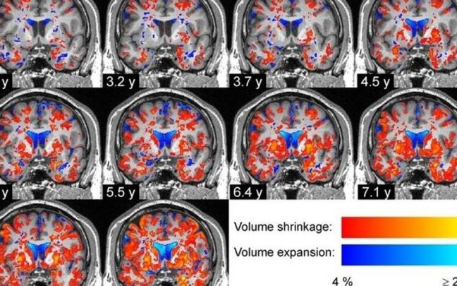 Degeneraci&oacute;n progresiva del tejido cerebral en un paciente con enfermedad de P&aacute;rkinson.